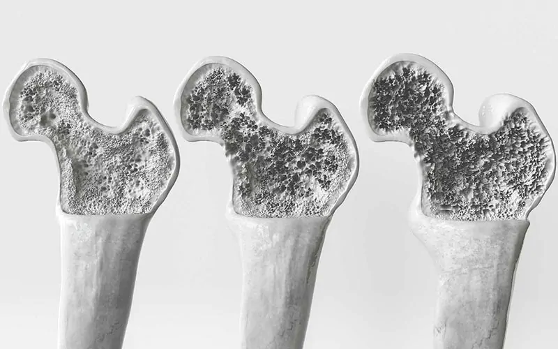 osteoporose uma doenca ossea silenciosa